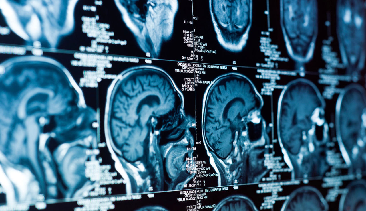 Poluarea aerului, asociată cu un risc crescut de tumori cerebrale.