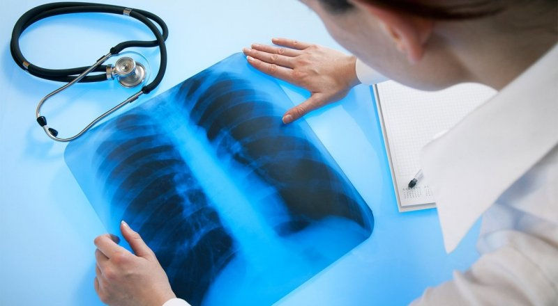 Mortalitatea cauzată de tuberculoză a scăzut în Moldova.