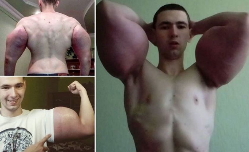 Tragic: Riscă să rămână paralizat, după ce și-a injectat ulei în bicepși
