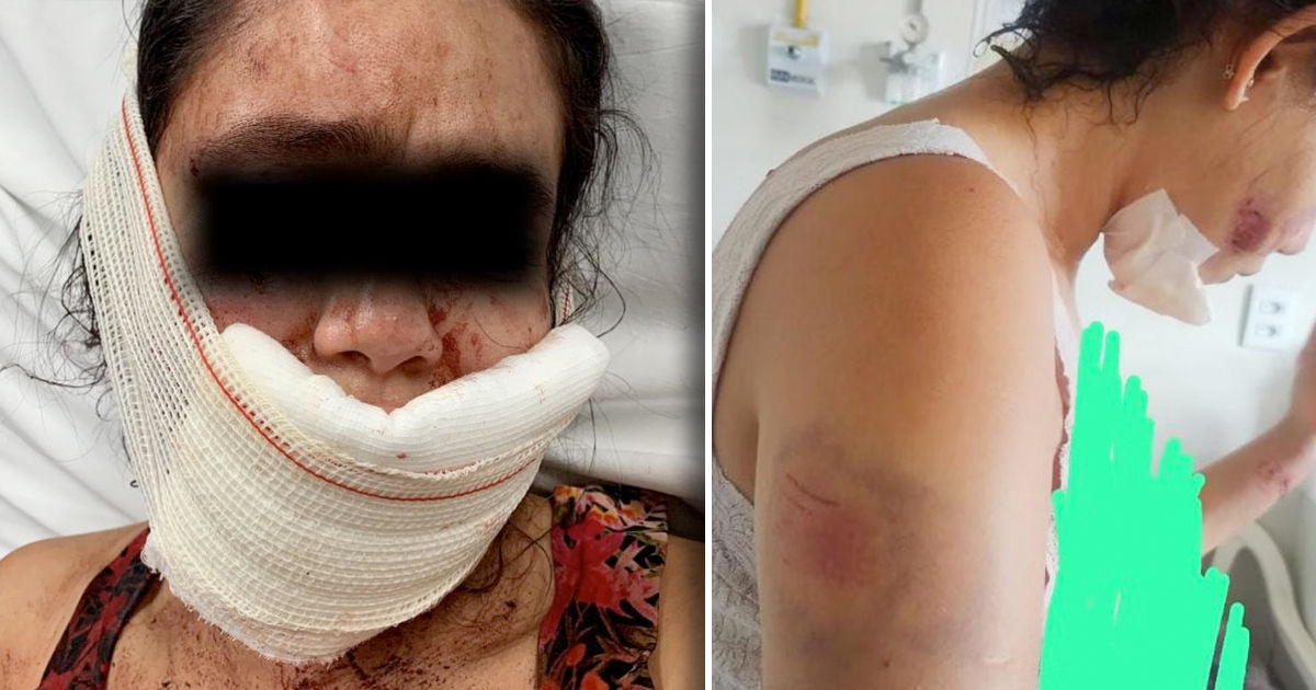 В Бразилии мужчина в гневе накинулся на свою девушку и искусал ее лицо.