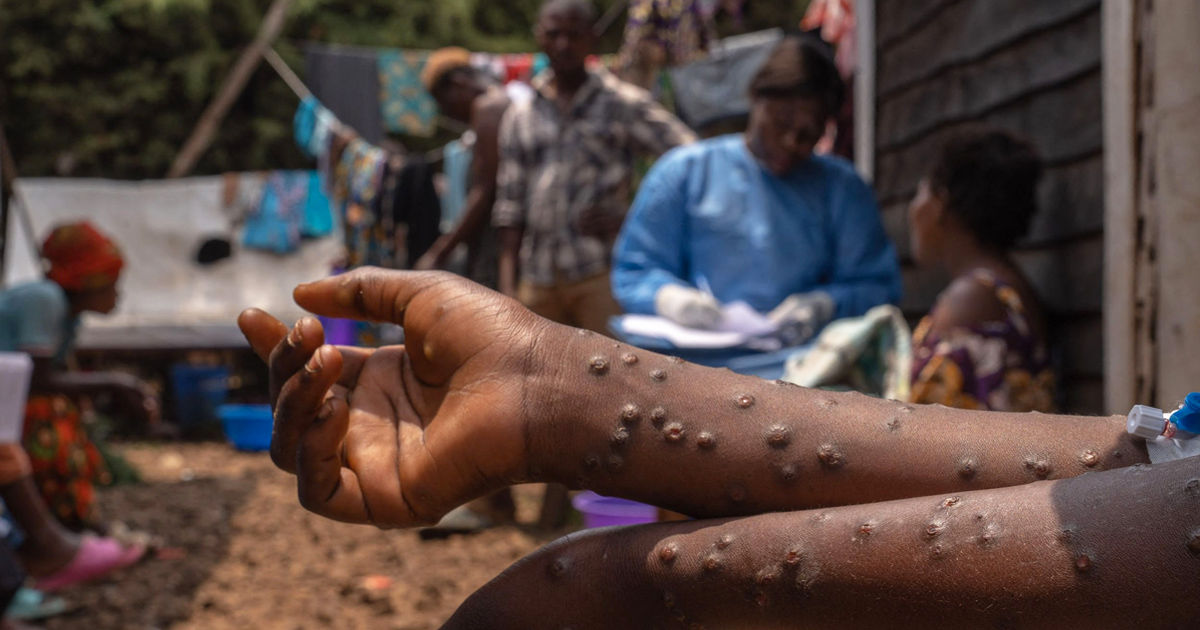 Peste 100 de bolnavi de variola maimuței au fugit din centrele de tratament din Congo.