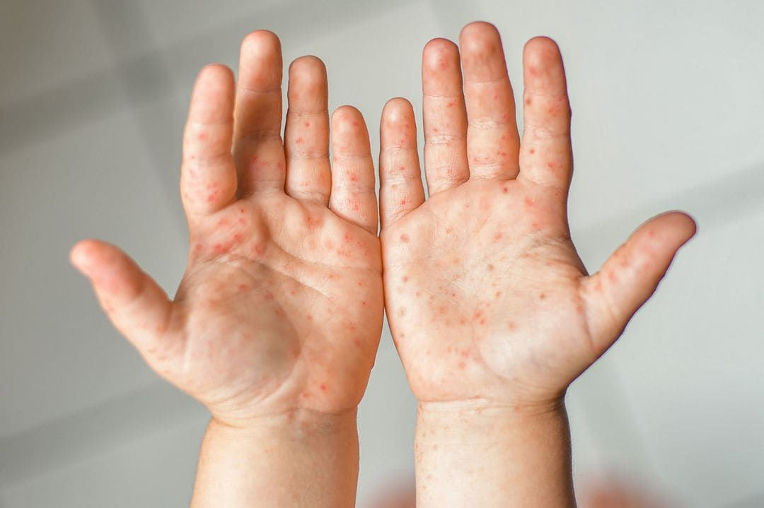 Noi cazuri de rujeolă, confirmate în municipiul Chișinău: Toate persoanele sunt nevaccinate.