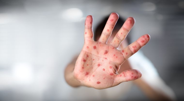 OMS: Cifra bolnavilor de rujeolă în Europa a crescut cu 400 %