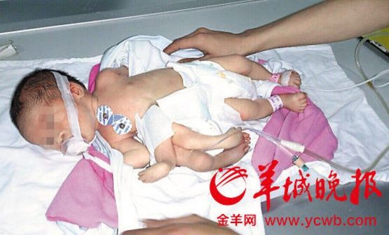 В Индии успешно прооперировали ребенка, родившегося с восемью конечностями.