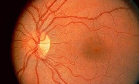 Aşa-numita "Bio-Retină", realizată de o firmă israeliană, va putea fi implantată sub anestezie locală în doar 30 de minute