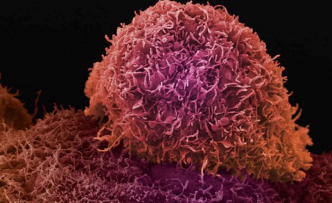 Testul a fost realizat de o echipă medicală de la Cancer Research UK, coordonată de medicul Harpal Kumar.