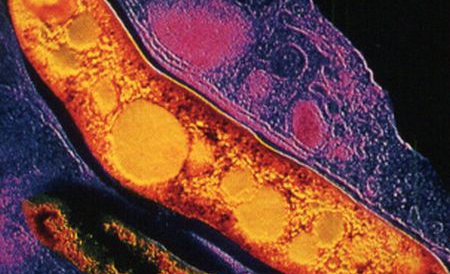 Cel mai periculos tip de tuberculoză este XDR, care rareori răspunde la tratatament. 