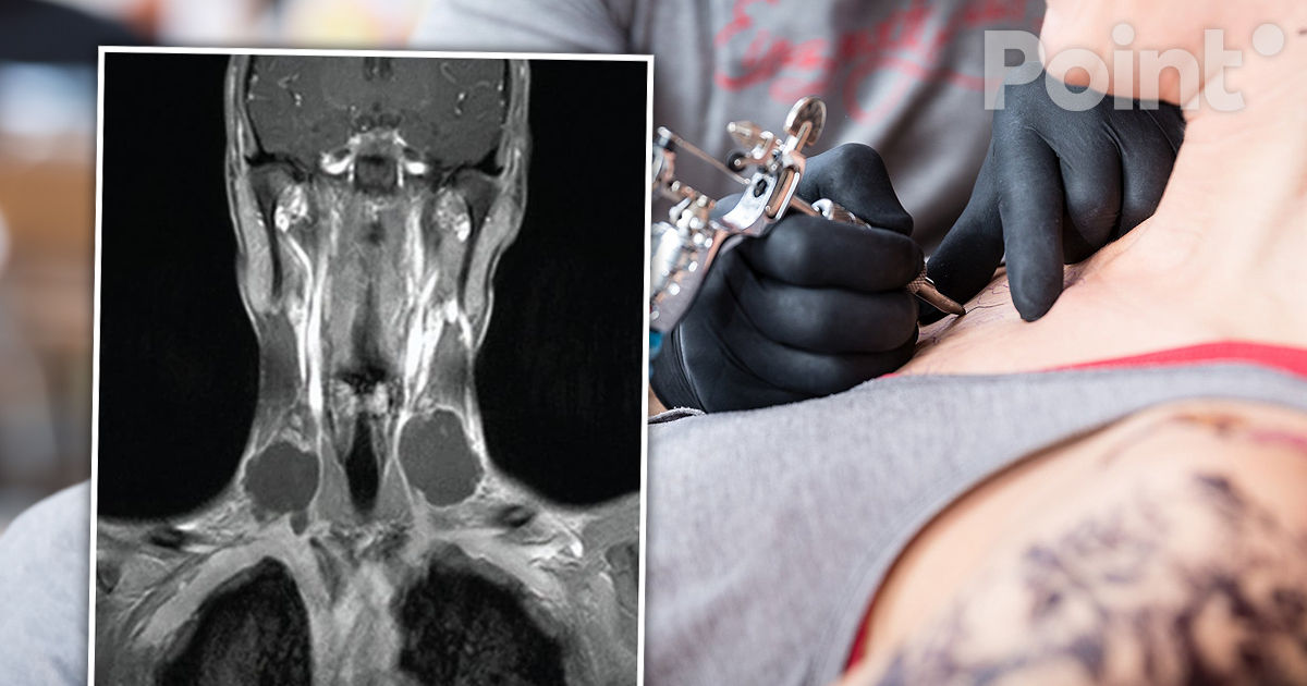 Un tatuaj în formă de cruce pe gâtul unui tânăr s-a transformat într-un ulcer necrotic.