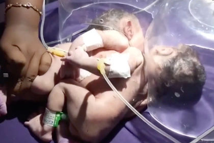 Сиамские близнецы родились с одним сердцем на двоих.
