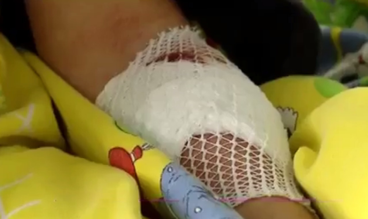Copilul mușcat de un maidanez, în stare gravă şi cu faţa desfigurată. Foto: captură  video