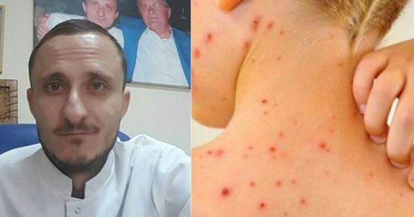 Михай Стратулат рассказал о последствиях отказа от прививок против кори.