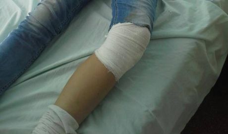 O fetiţă de 10 ani din Cahul a fost atacată şi muşcată de trei câinii maidanezi. Foto: jurnal.md