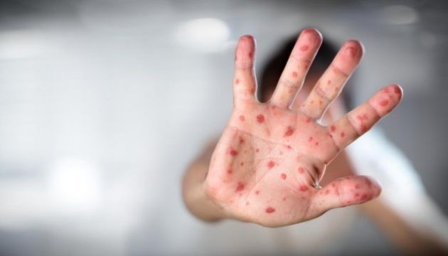 В Кишиневе зарегистрирован новый случай подозрения на корь.