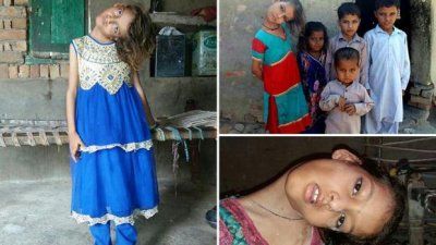 Caz șocant în Pakistan: O fetiţă are gâtul întors la 90 de grade