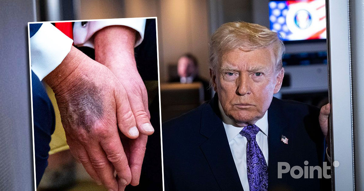 Donald Trump a explicat motivul apariției vânătăilor pe mâinile sale.