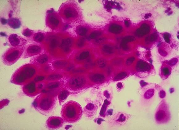 Vaccinul anticancer începe să fie testat pe oameni. Foto: Digi24