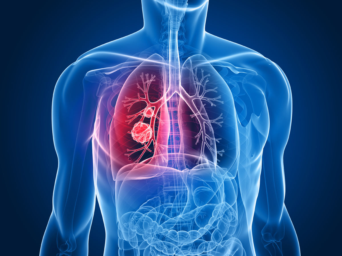 Cel mai de temut ucigaş dintre toate afecţiunile oncologice. Foto: pasadenacyberknife.com