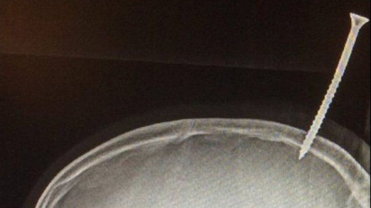 Un șurub de 15 cm a perforat creierul unui băiat de 13 ani.