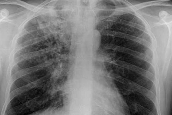 86% dintre cazurile de tuberculoză din Moldova sunt la copii