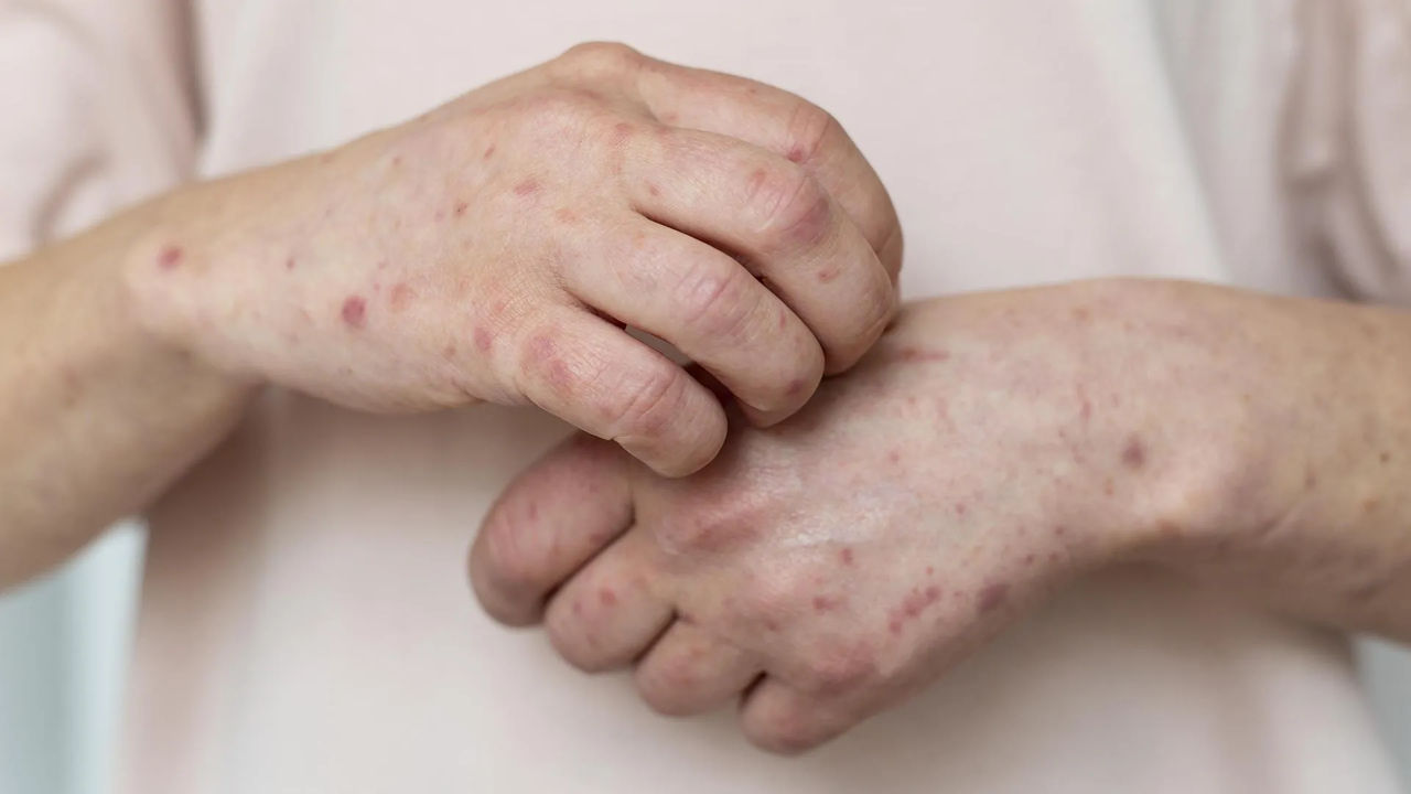 Rujeola face ravagii în Moldova: Cinci persoane infectate, una suspectă.
