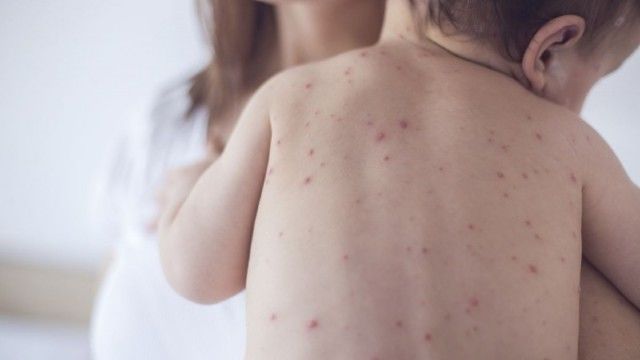 Organizaţia Mondială a Sănătăţii avertizează că Europa este lovită de o epidemie de rujeolă. 