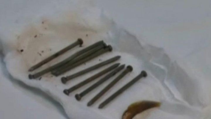 Incredibil: Sute de cuie și monede, extrase din stomacul unui bărbat