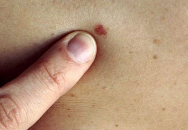 Cancerul este a doua cea mai comună cauză a deceselor, dar boala poate fi tratată, dacă este diagnosticată la timp.