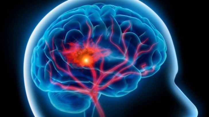 Cum poţi salva un om care suferă un accident vascular cerebral. Foto: realitatea.net