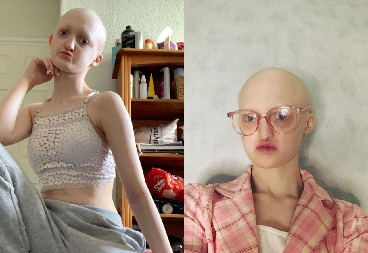 Лысая и глухая девушка с редким заболеванием стала моделью на зависть всем.