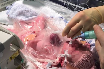 Девочка осталась жива, но ее здоровье в будущем зависит от продолжающегося лечения. 