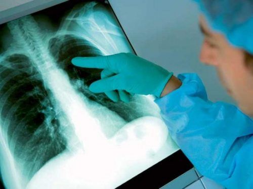 Alertă cu tuberculoză în satul Suruceni. 