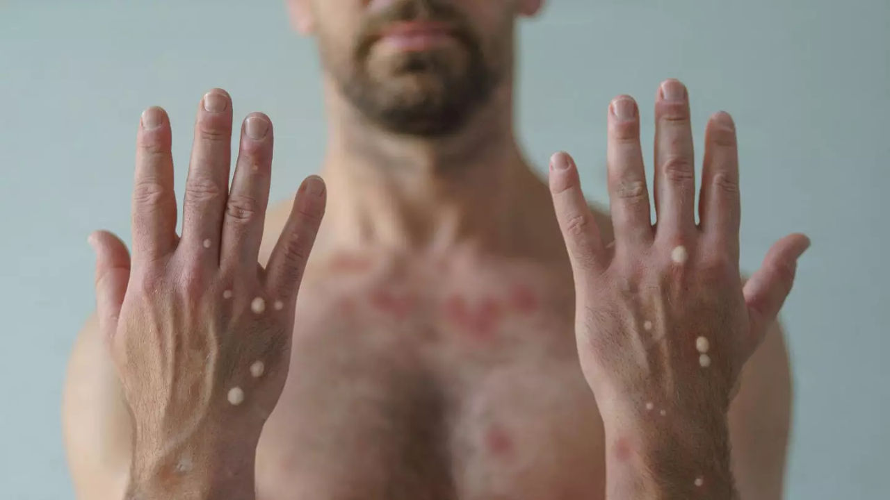 ВОЗ выбрала новое название для оспы обезьян — mpox.