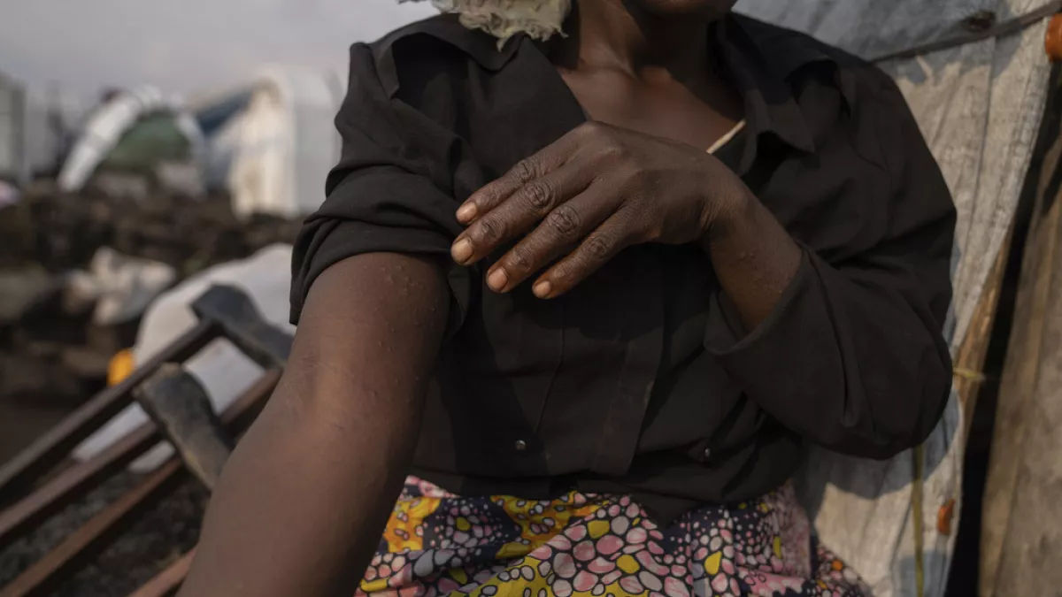 UE exclude introducerea de controale la frontiere sau vaccinarea împotriva mpox.