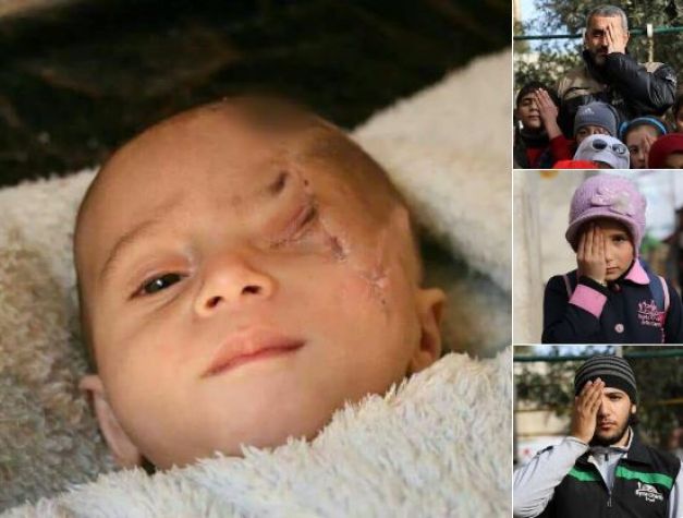 Siria: Un bebeluş care şi-a pierdut un ochi într-un bombardament al forţelor lui Assad devine un simbol pe Internet