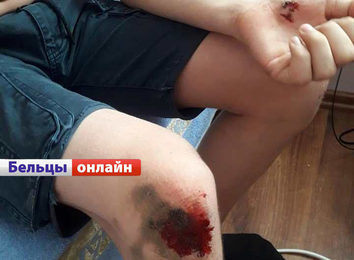 В Бельцах свора собак напала на 12-летнего мальчика