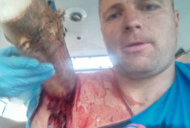 Продырявленный бревном насквозь белорус сделал селфи