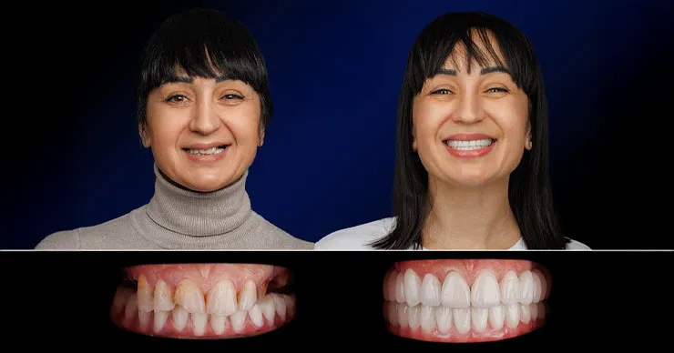 Dentus: 5 причин выбрать европейские зубные импланты Lyra