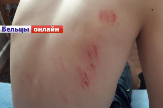 В Бельцах свора собак напала на 12-летнего мальчика