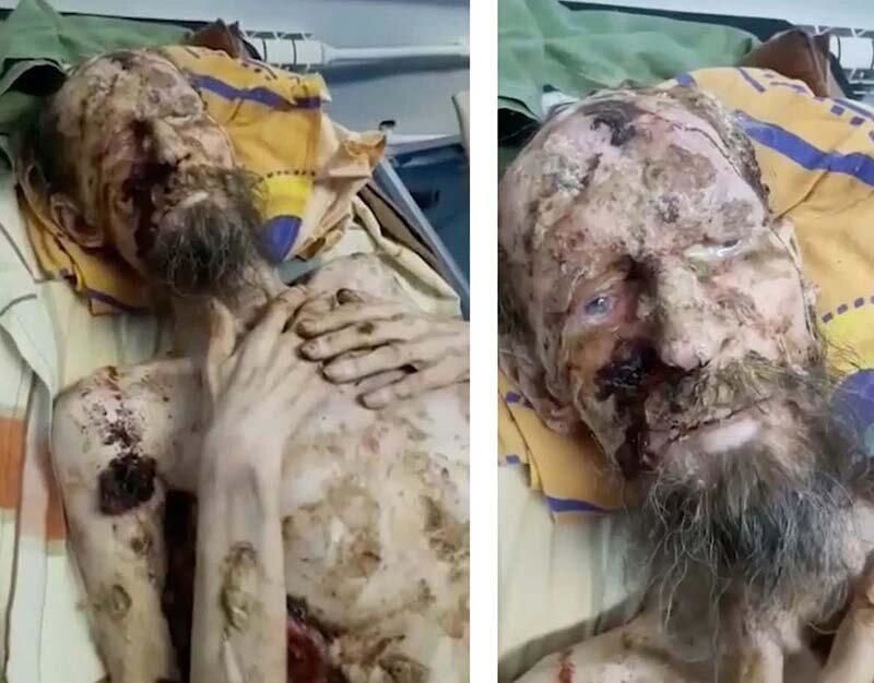 Мужчина со сломанным позвоночником месяц жил в медвежьей берлоге