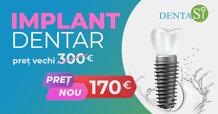 Dentasi.md: Зубной имплант по самой низкой цене в Молдове - 170€