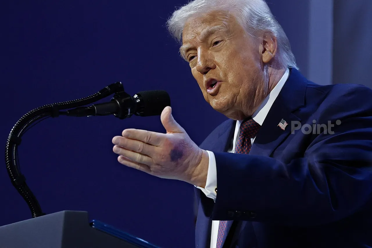 На руке Трампа увидели новый огромный синяк