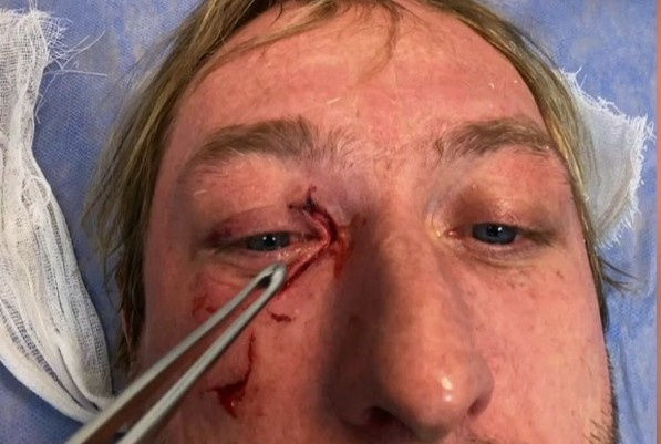 Плющенко получил серьёзную травму: "Ещё миллиметр — и глаза бы не было"
