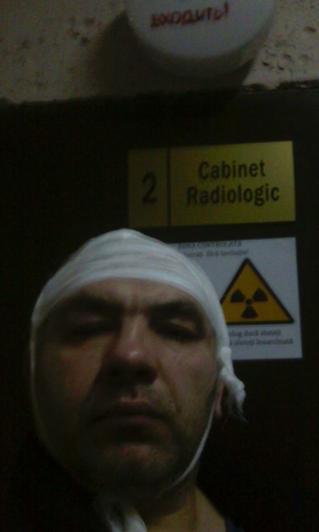 Борец с коррупцией в МВД Анатол Матасару попал в больницу с разбитой головой
