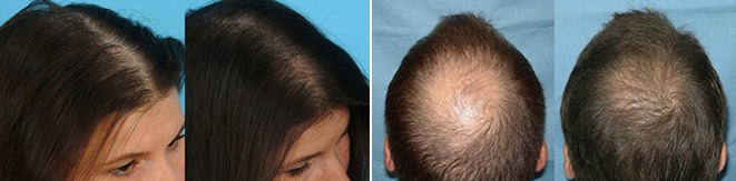 Как выпрямить волосы после химиотерапии навсегда