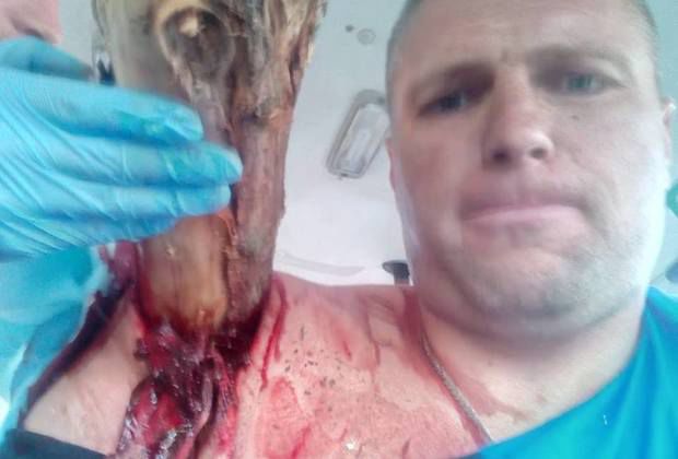 Продырявленный бревном насквозь белорус сделал селфи