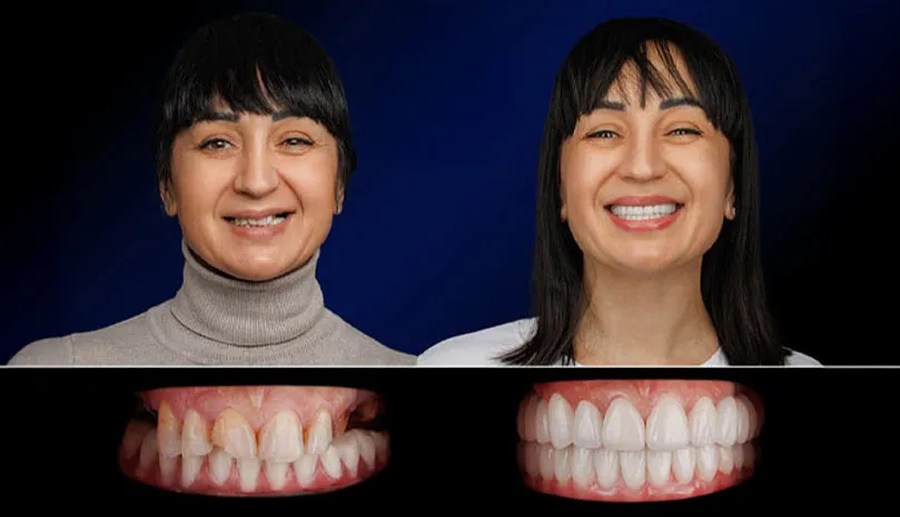 Dentus•Dentino: 5 motive să alegi implanturile dentare europene Lyra