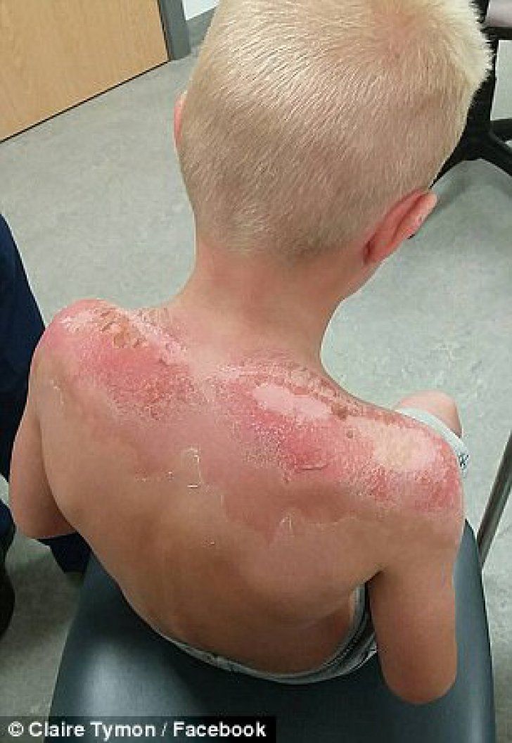 Şocul unei mame, după ce şi-a dat copiii cu loţiune de plajă cu SPF 50: "Arată ca şunca prăjită"