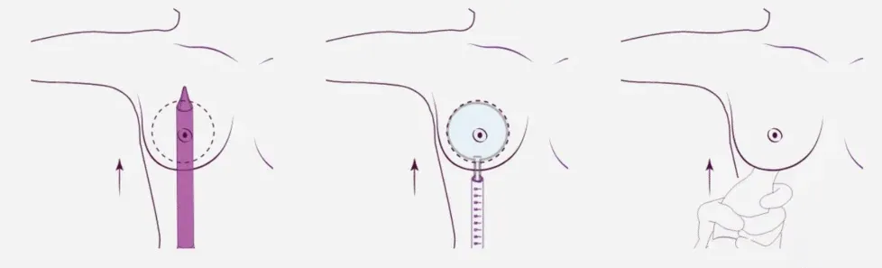 Un nou standard în augmentarea mamară: Medpark introduce metoda Preservé, în premieră națională