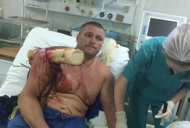 Продырявленный бревном насквозь белорус сделал селфи