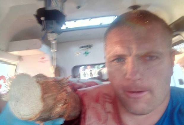 Продырявленный бревном насквозь белорус сделал селфи